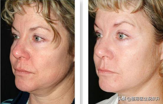 脸色蜡黄毛孔粗大,脸色暗沉光子嫩肤