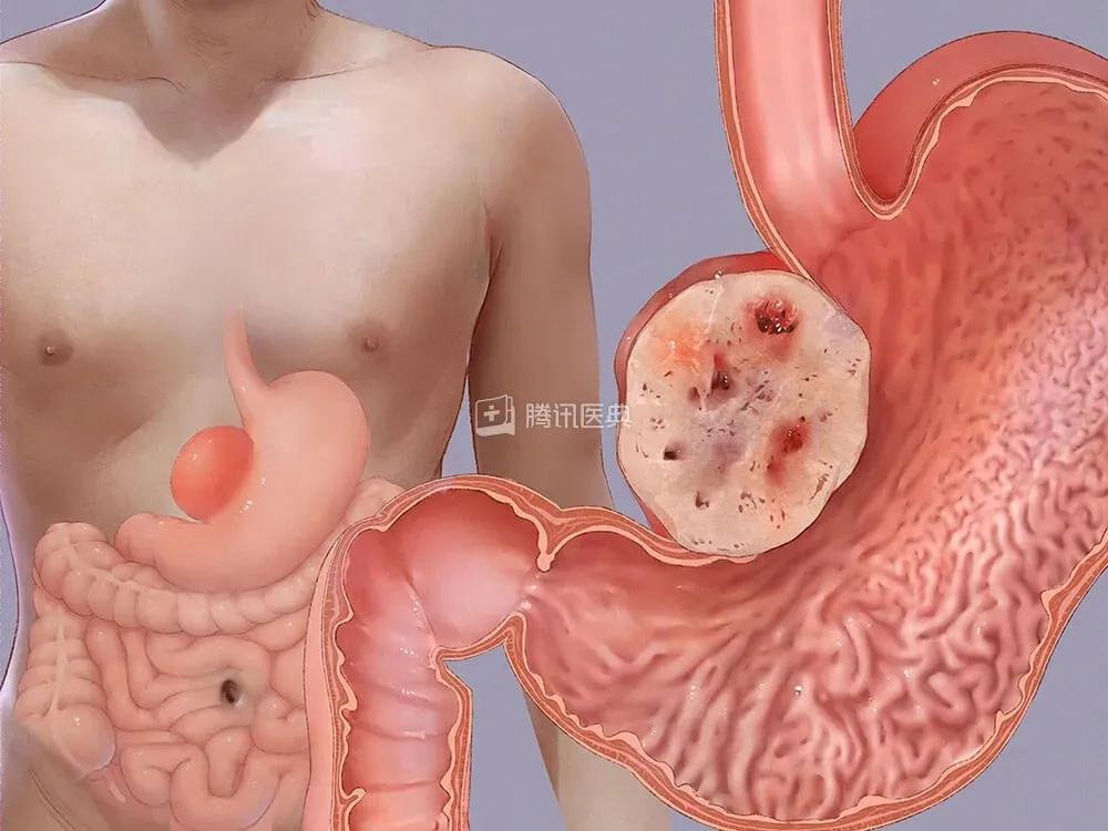 深圳癌症发病率最高的城市,深圳癌症多少例