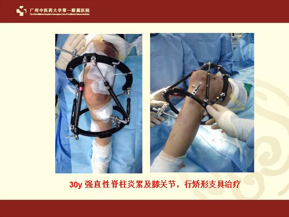 膝关节变形手术,膝关节退化变形矫正手术