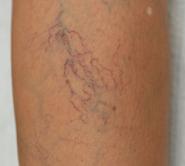 “医生,我腿上一条条青筋是怎么回事,像蜘蛛网、像蚯蚓”