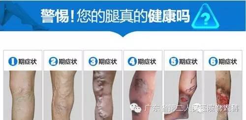 静脉曲张硬化治疗广泛应用…细针解决老难题，难看的蚯蚓腿不见了
