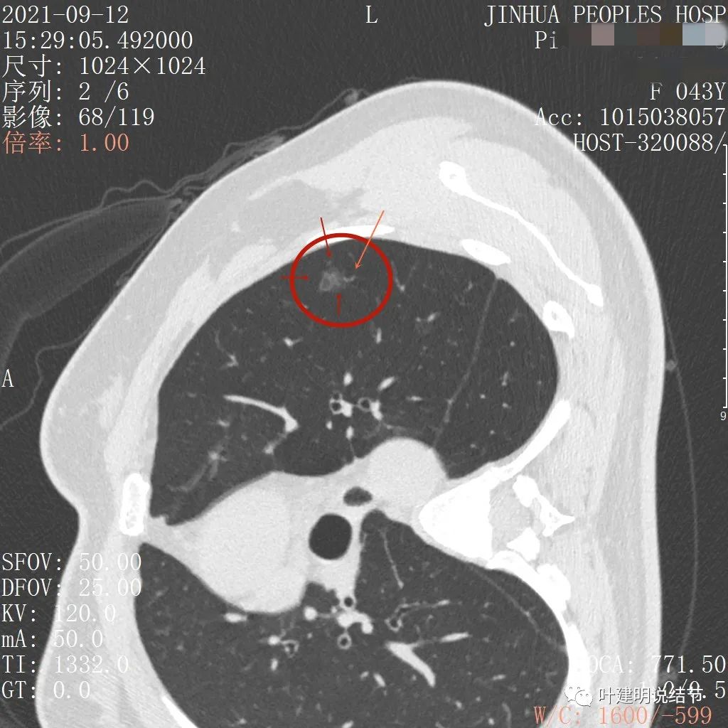 从活检怎么看是非小细胞癌,从病例谈辨证论治