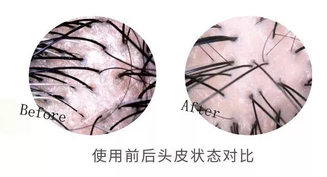 “十男八秃”的日本男人疯抢这瓶小黑钻!让头发不再掉了