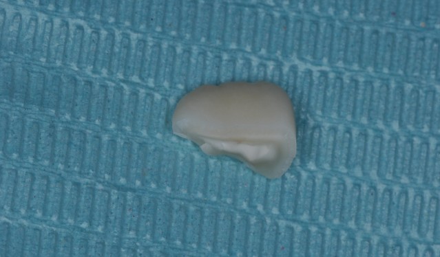 牙拔掉后扔掉还是留着,牙折断还能接回去吗