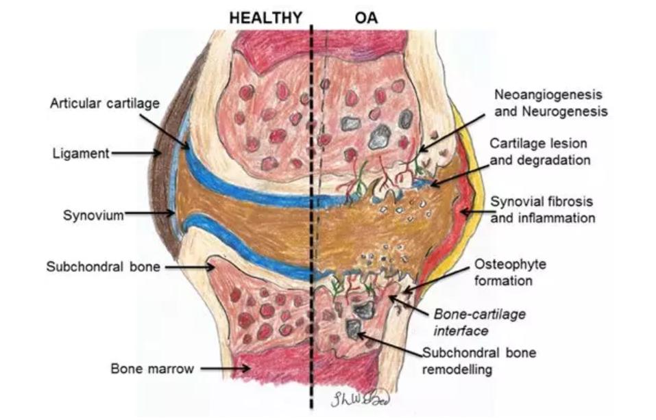 prp治疗膝关节骨性关节炎你知道吗,退行性膝关节炎prp治疗效果如何