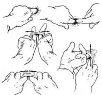 肛裂要如何治疗,倪海厦治疗肛裂