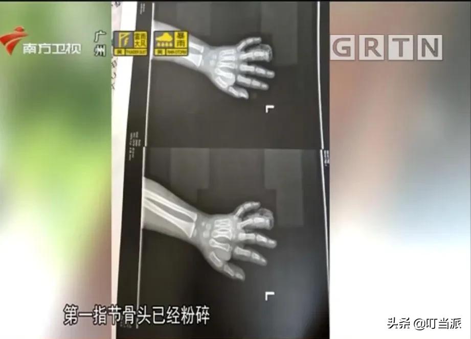 小孩玩健身器材死亡后续,小男孩玩健身器材时夹骨折