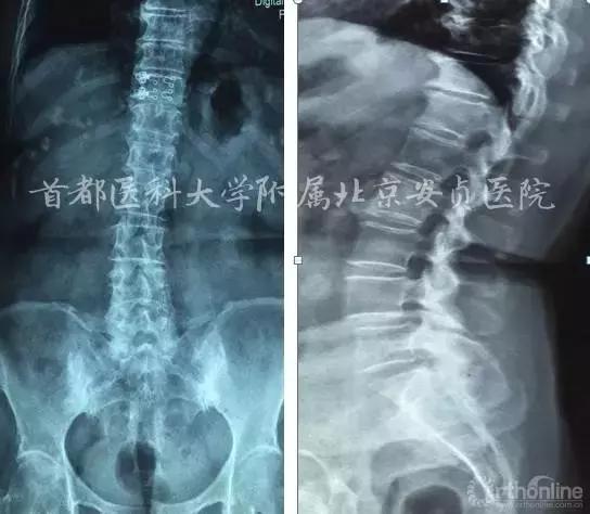 颈椎病引起的胸闷胸痛在哪个部位,颈椎病会引起咳嗽胸闷胸痛吗