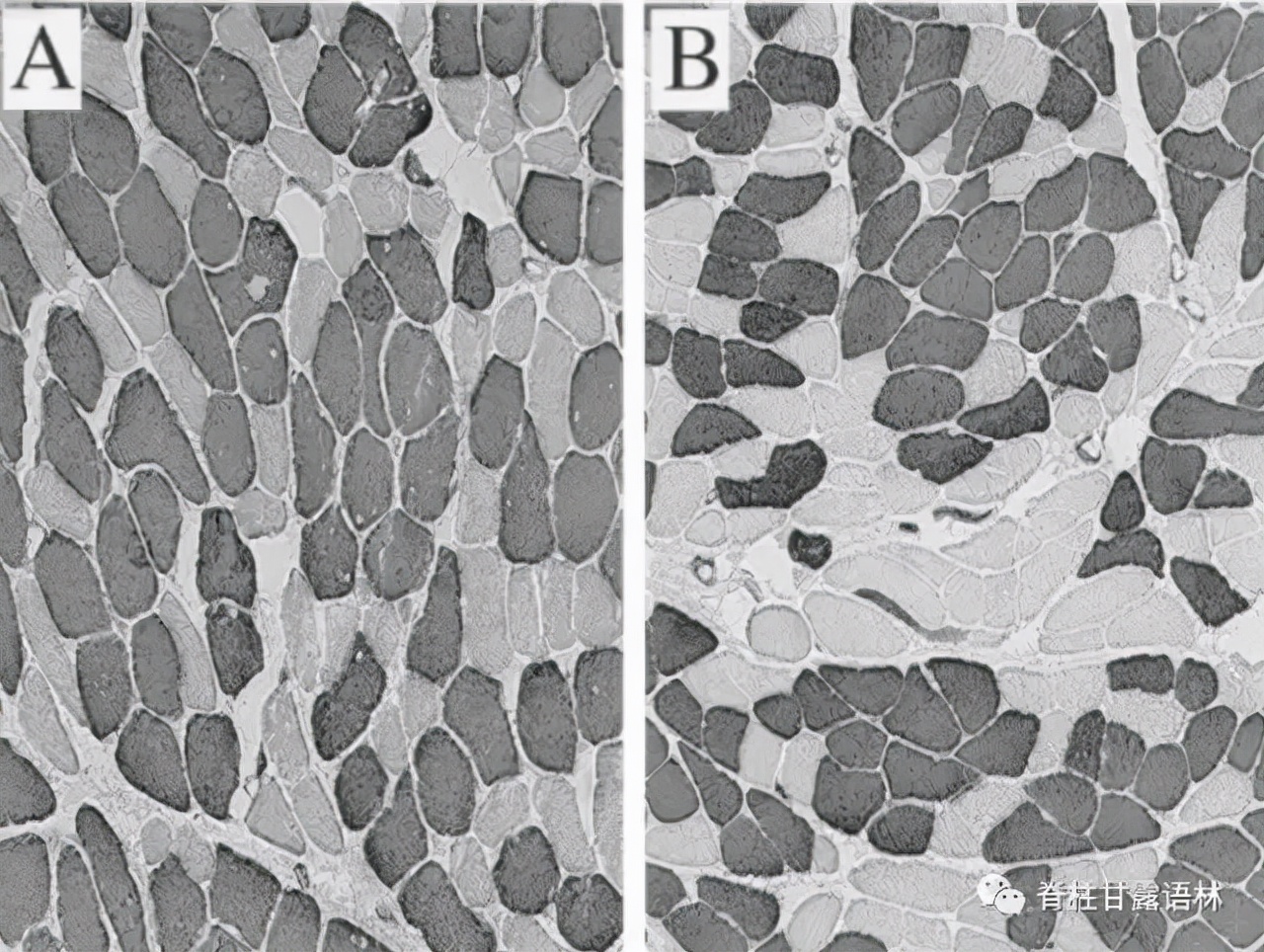 腰椎间盘突出中央型和旁侧型,腰椎间盘与椎板间隙的对应关系