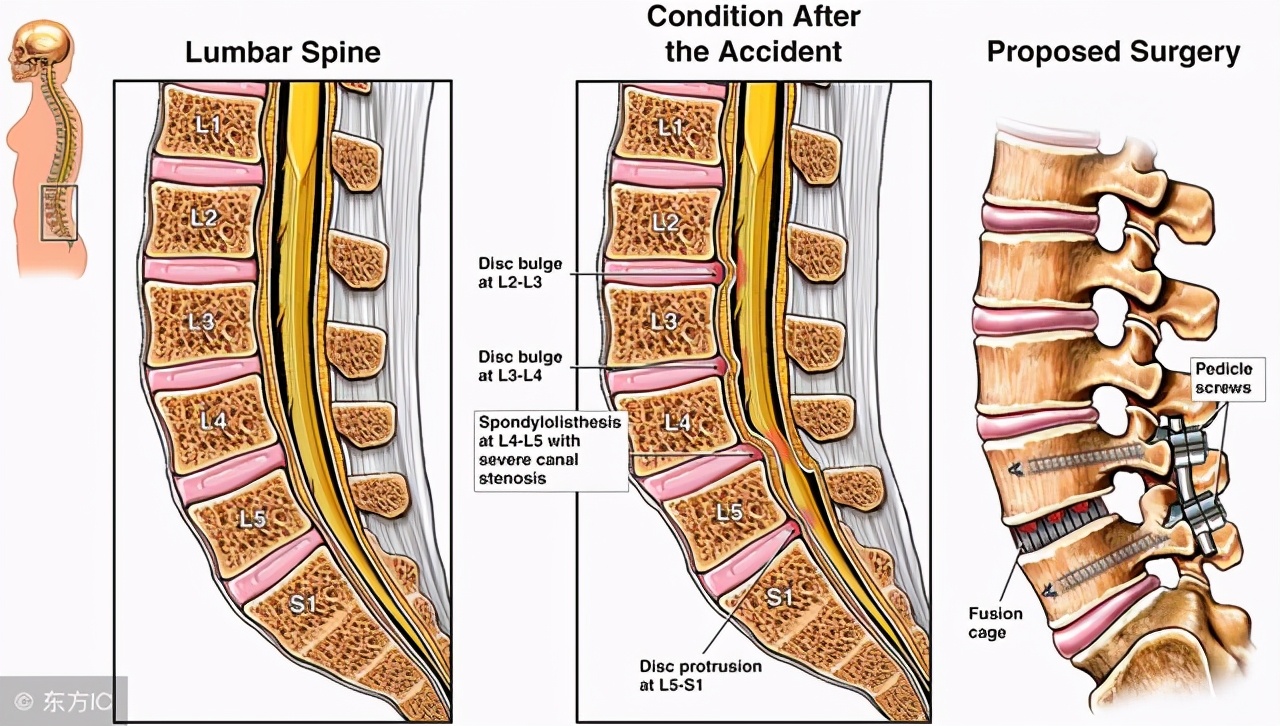 腰椎滑脱和腰椎滑移是一个概念吗,腰椎滑脱是不是骨折的意思