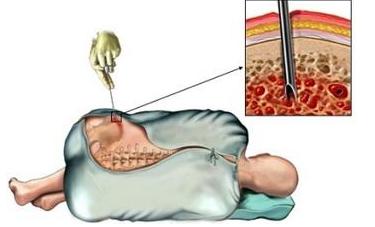 骨穿疼吗,骨穿麻不麻醉