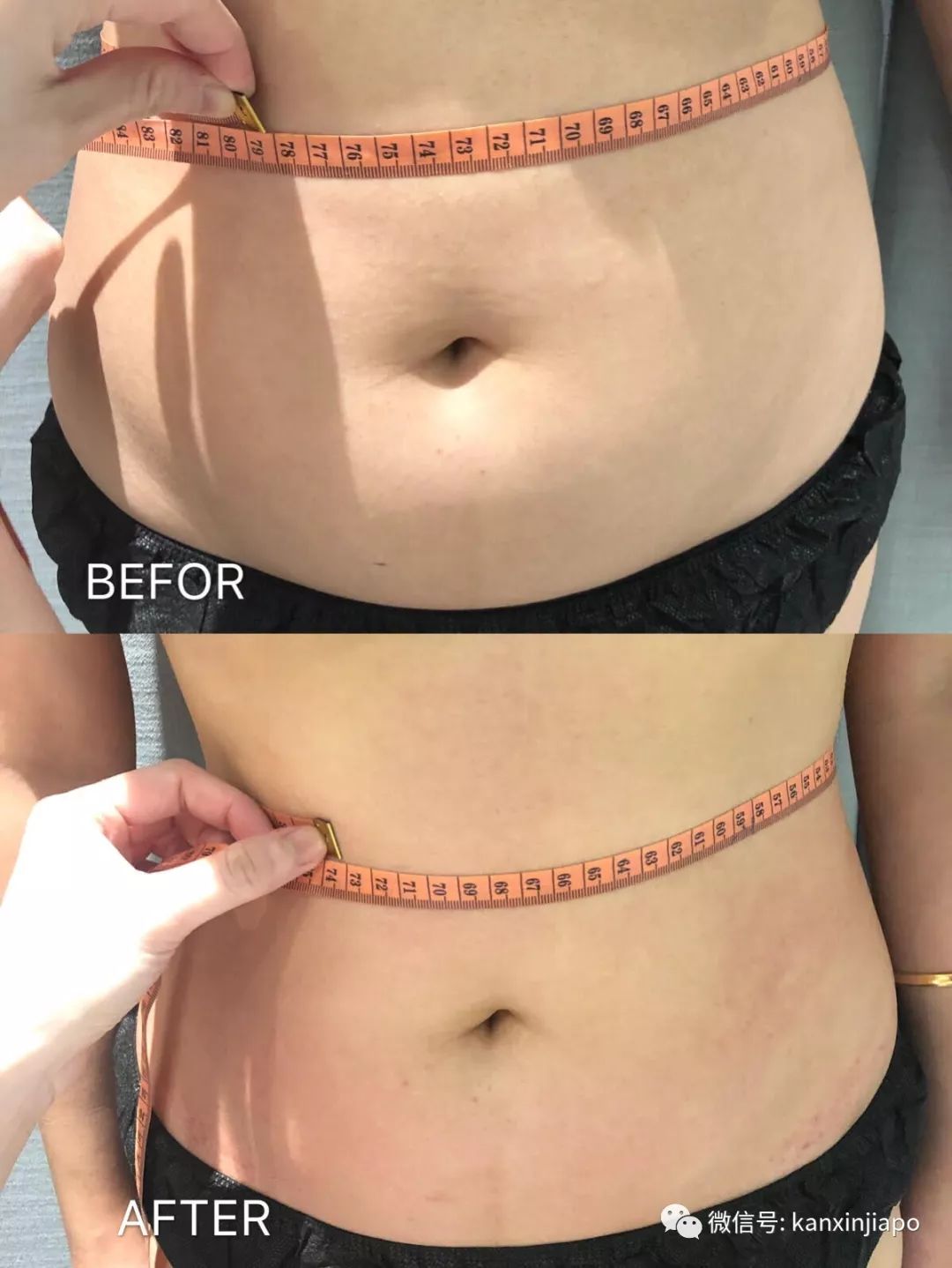 额头长闭口毛孔粗大爆痘怎么办,皮肤爆痘起闭口怎么回事