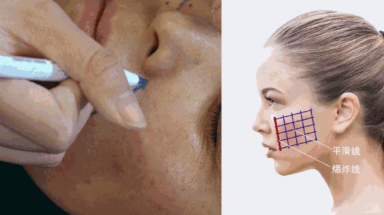 30岁下颌缘提升还有用吗,30岁下巴后缩能矫正吗