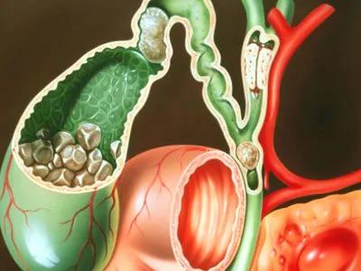 得了胆管癌该怎么办,得了胆管癌能活多久