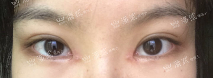 女孩眼部整形失败,内眼角整形失败