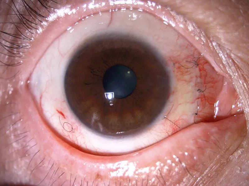 眼睛长出翅膀,眼睛长翅膀