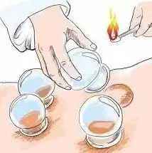 不是所有人都适合拔罐疗法,常见的拔罐方法有几种