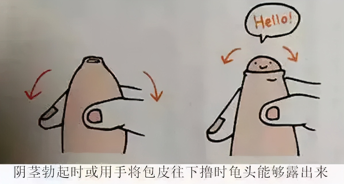 割包皮能当天做当天走吗,割包皮当天去医院当天就能割吗