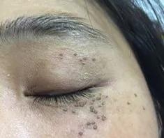 长了这么多年汗管瘤，你还以为是脂肪粒？