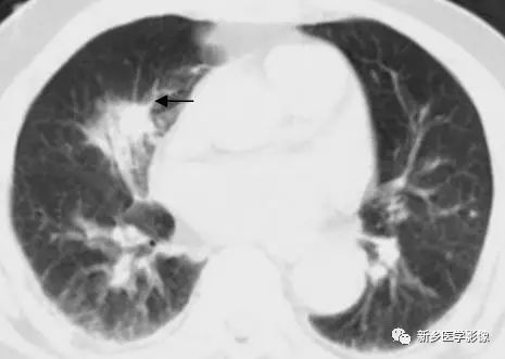 肺部基础免疫,肺基础疾病有哪些