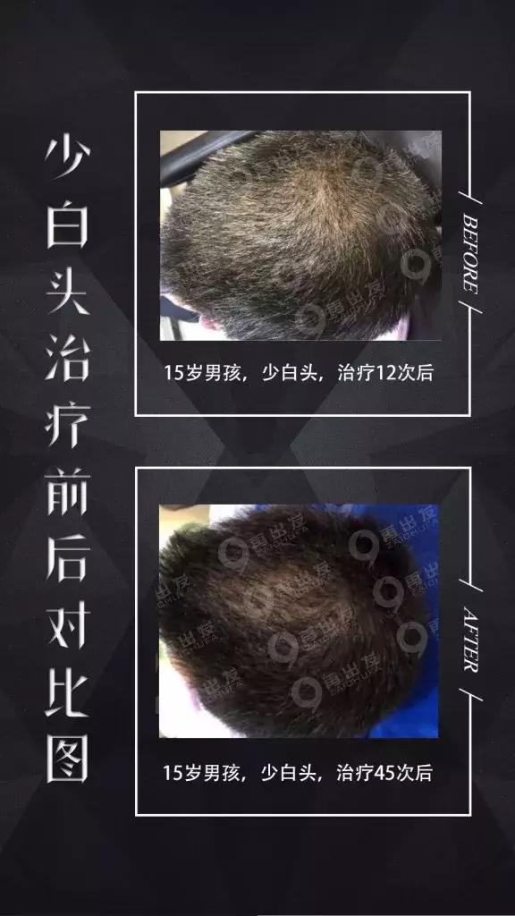 年纪轻轻的为什么头发白了,年纪轻轻头发白了一撮怎么办