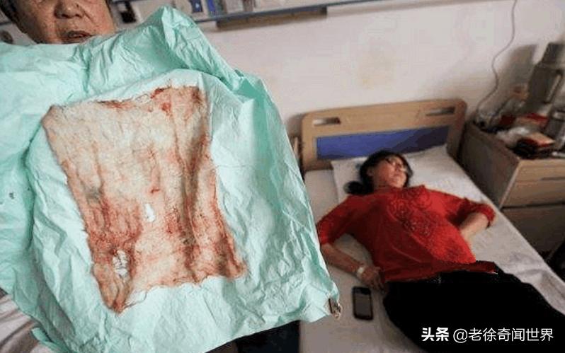 女子下身疼痛5年,医生从中取出一样东西,老公看后脸都气绿了