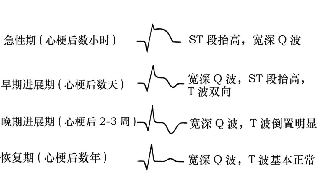 如何辨别真假心肌缺血,心肌缺血的亲身经历