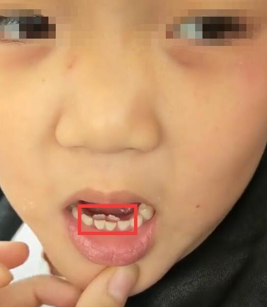 6岁小孩长了双排牙怎么办,6岁小孩长出双排牙是不是龅牙