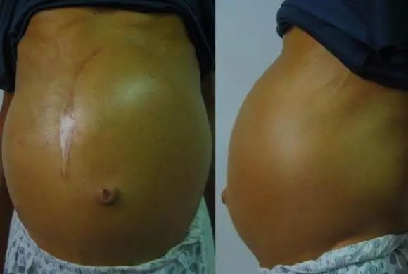 得了肝腹水需要注意哪些,引起肝腹水的5个常见因素是什么