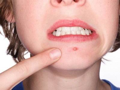 左脸长痘肝不好怎么解决,脸颊两侧长痘说明肝肺不好吗