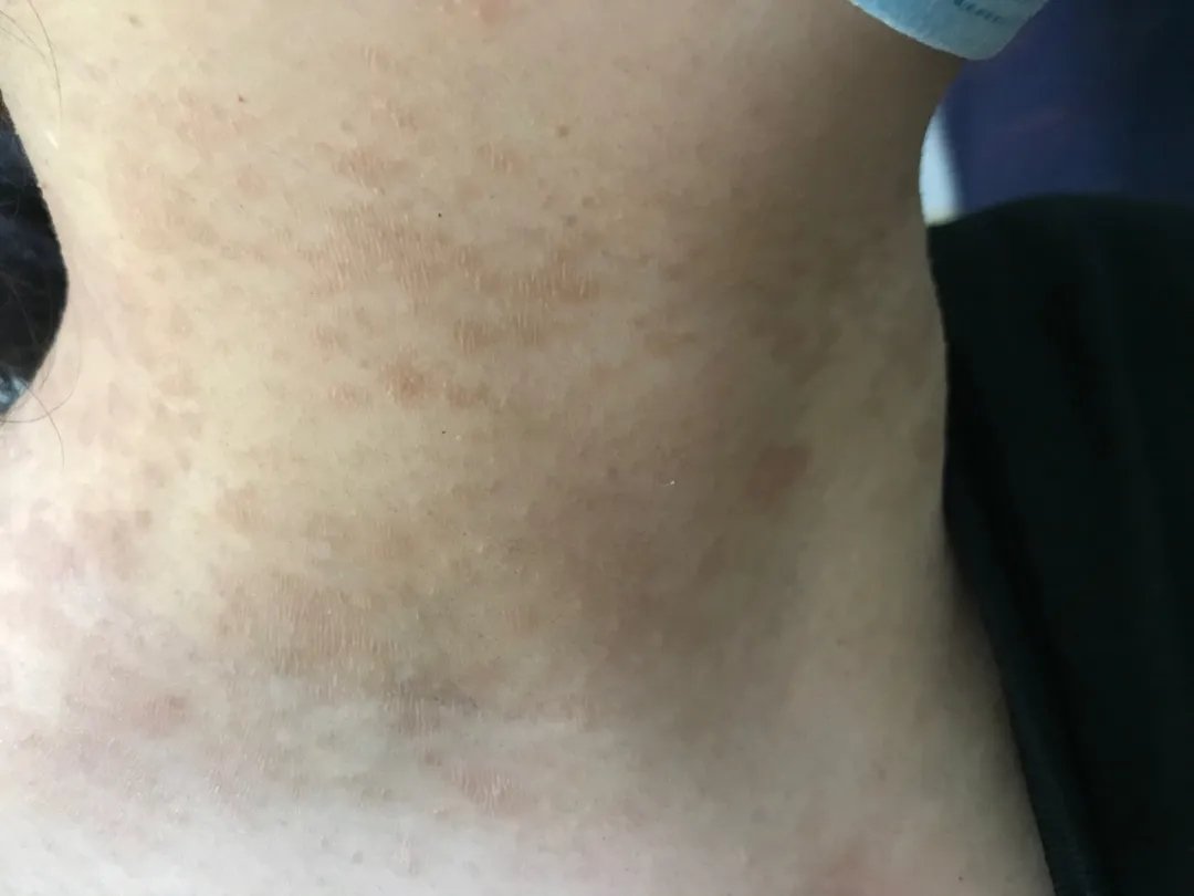 夏季常见皮肤病有哪些,谨防五种夏季高发病