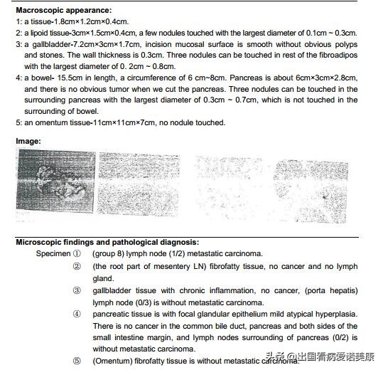对付胰腺癌的十个方法,用什么方法缓解胰腺癌