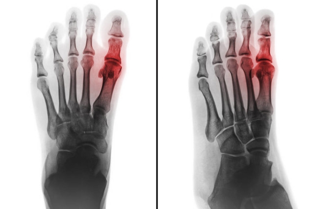 治痛风最便宜的消炎药有哪些,痛风急性发作吃止疼药没效果