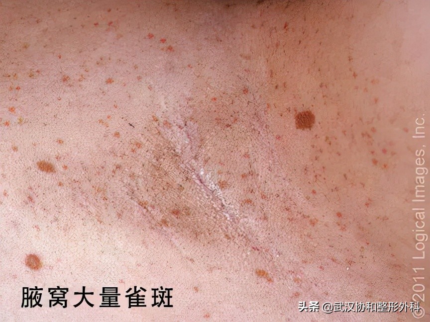 咖啡牛奶斑一定是神经纤维瘤吗,咖啡牛奶斑会突然出现吗