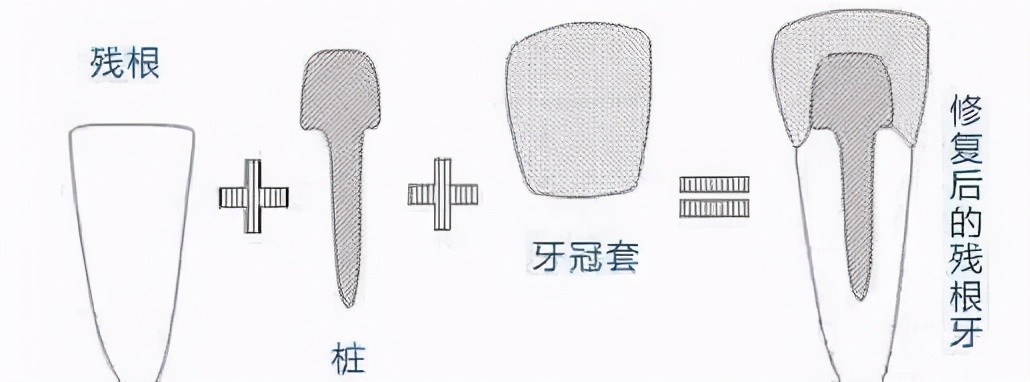 老牙崩掉一小块有事吗,吃骨头牙齿崩掉一块是什么病