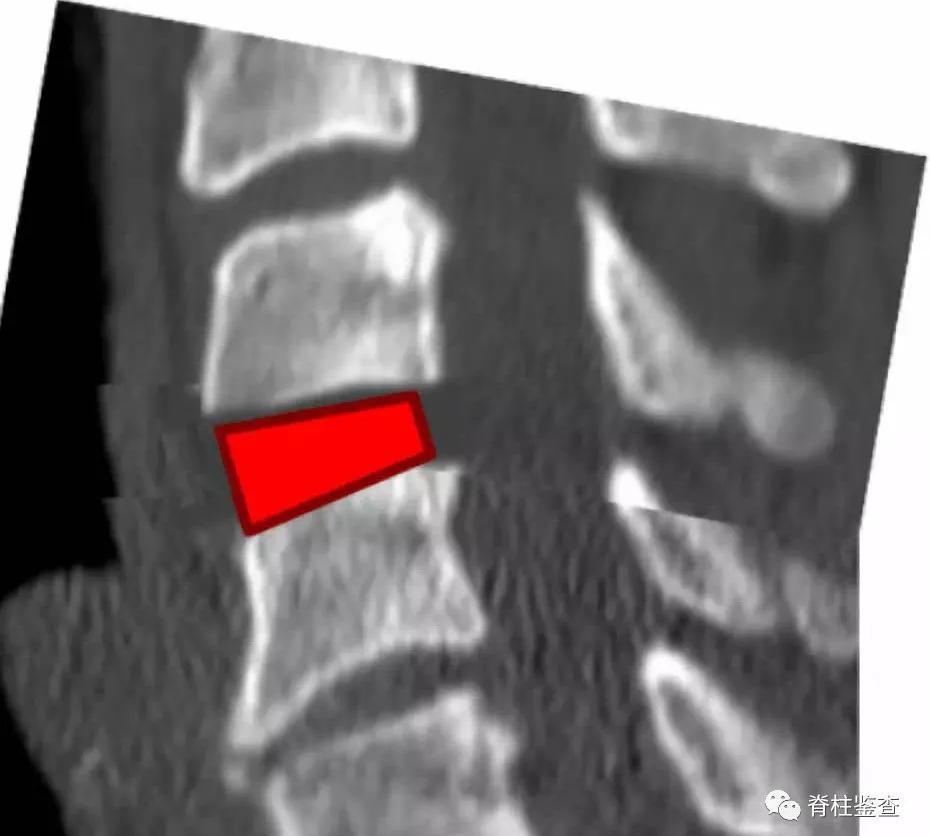 查出颈椎多节病变,颈椎生理曲度稍变直能恢复吗