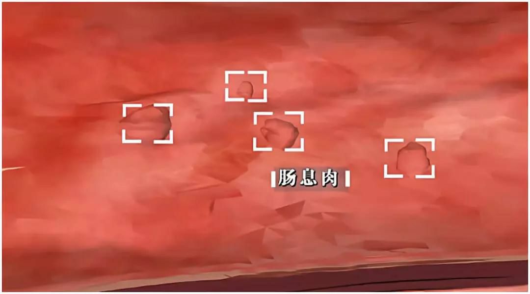 肠癌出现症状往往就是晚期吗,肠癌发现之前有哪些征兆