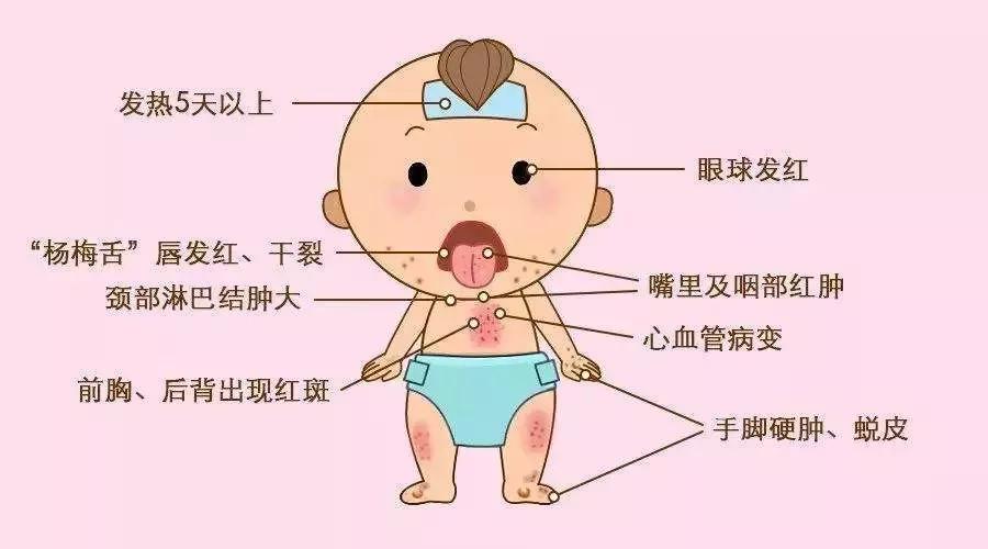 孩子反复高烧是吓到了吗,儿童高烧反复要警惕什么病