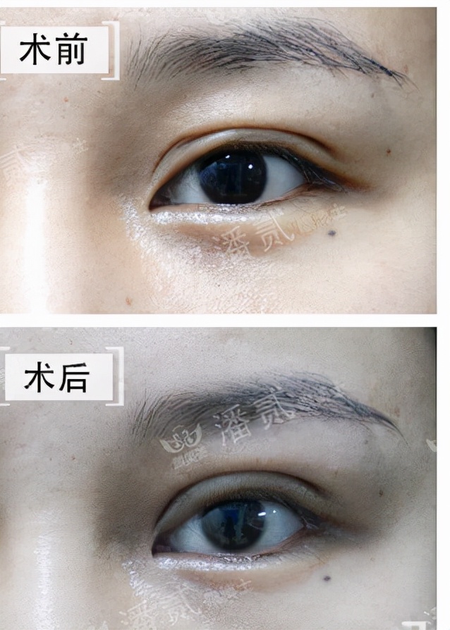 韩式三点式双眼皮手术很疼吗,韩式三点双眼皮做的不好看