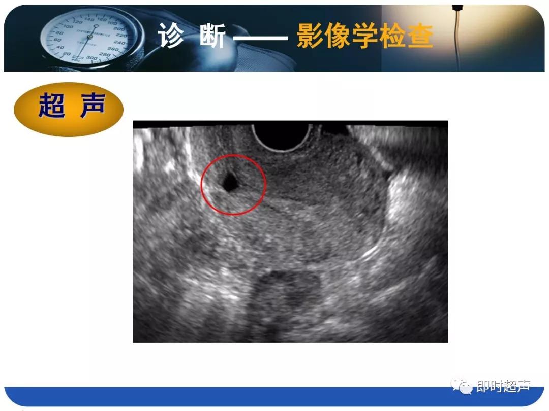 孕妇剖宫产瘢痕憩室,剖宫产瘢痕憩室息肉