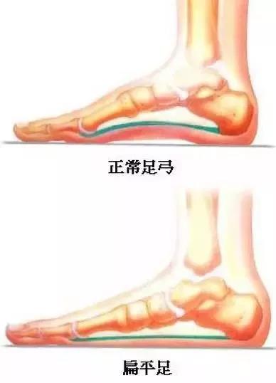 有效预防拇指外翻和扁平足,为了预防扁平足我们要穿什么鞋