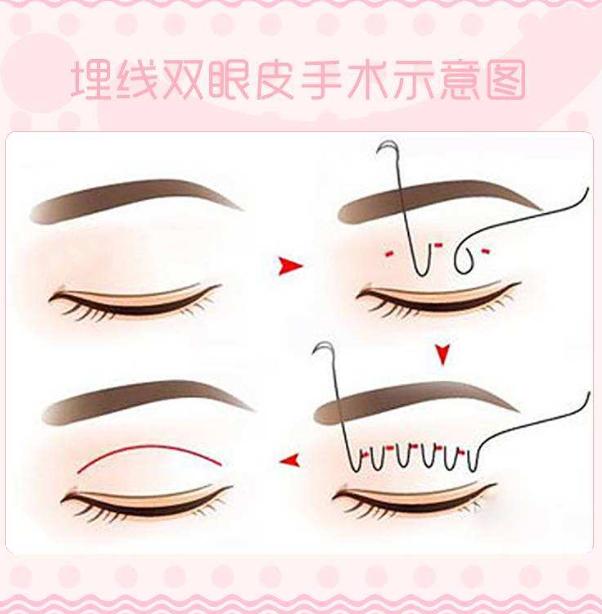 南华博士双眼皮,南华博士怎么样