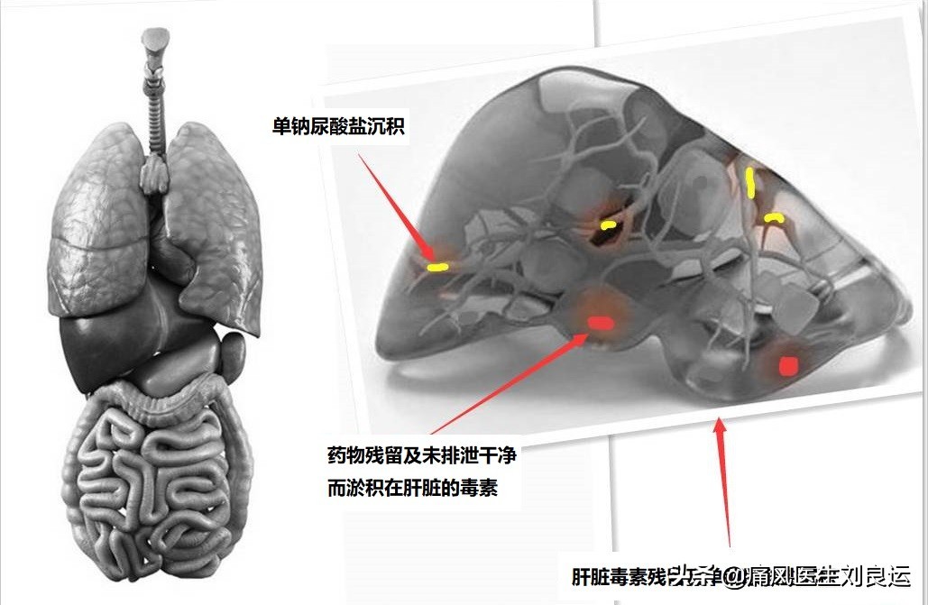 尿酸高吃什么药可降尿酸不伤肝,痛风吃什么降尿酸的药不伤肝