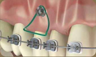 为什么有的人戴牙套要拔牙,为什么有的人戴牙套需要打钢钉