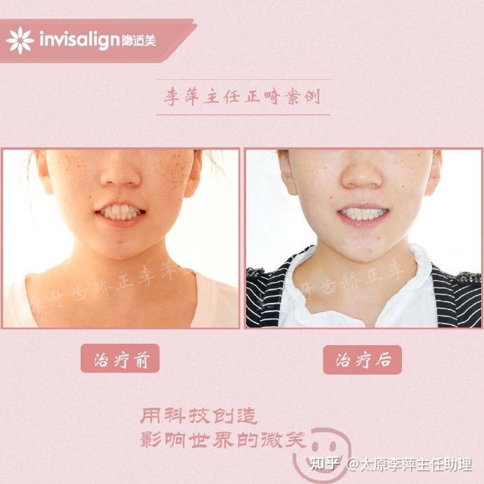 太原矫正牙齿需要做正颌吗,太原牙齿二次矫正