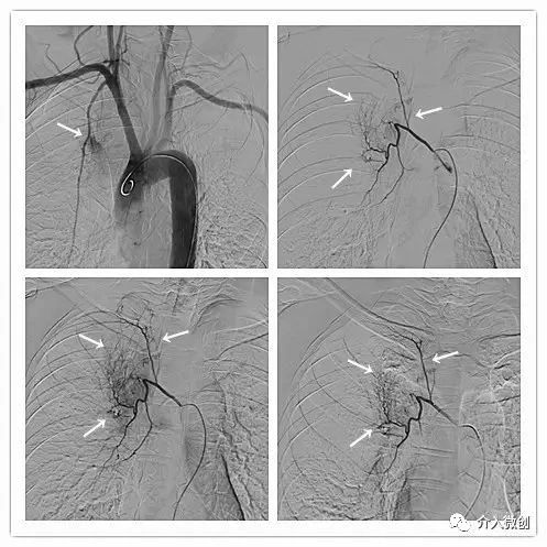 肺神经内分泌癌早期手术好吗,肺部神经内分泌肿瘤治疗
