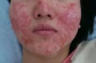 接触性皮炎的西医鉴别诊断,接触性皮炎临床表现有哪些