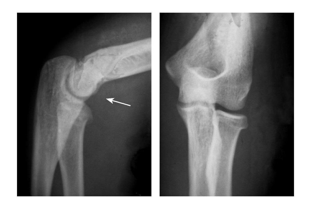 青少年肘部损伤最常见的是,肘部桡神经损伤的临床表现