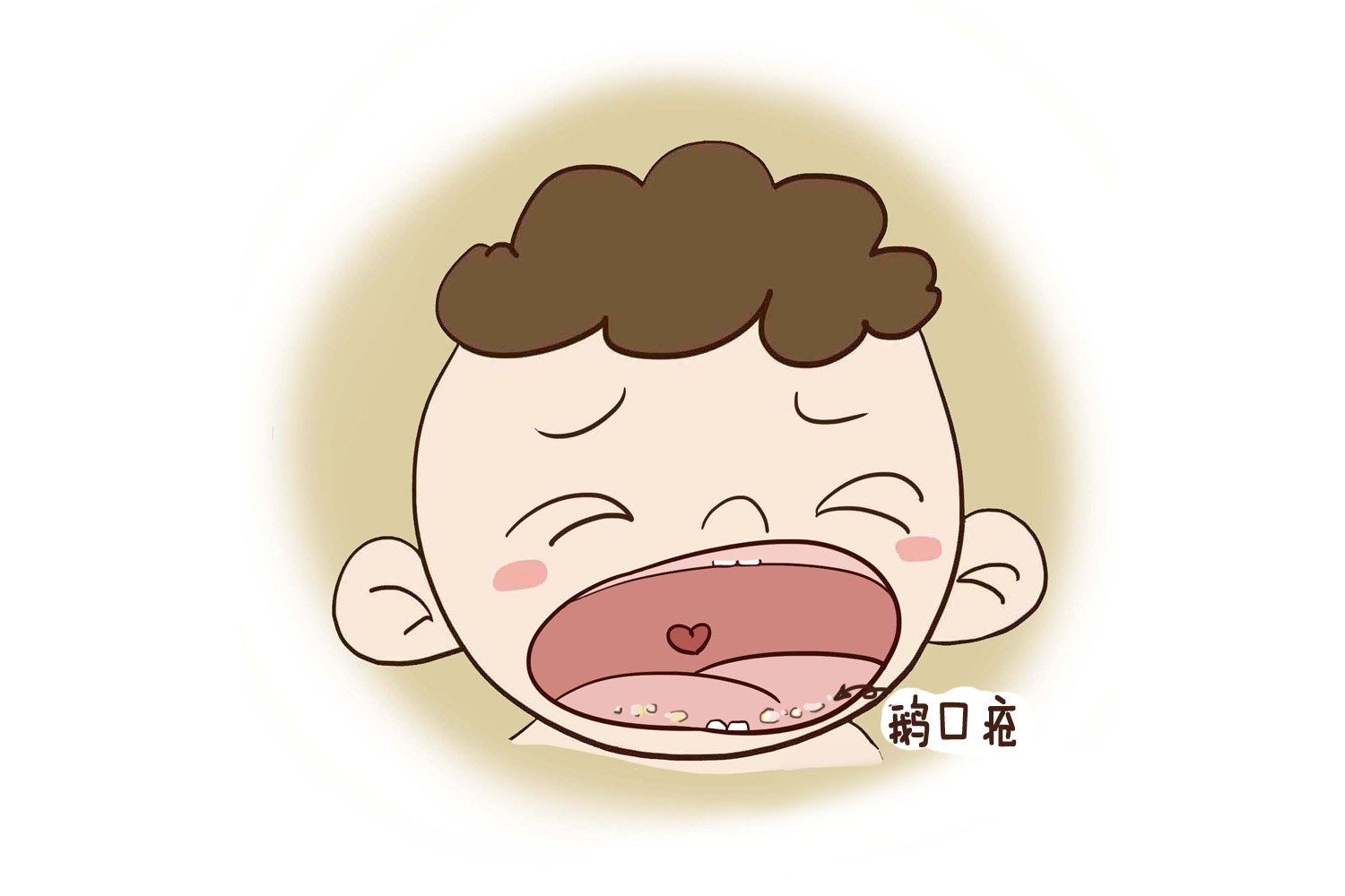 如何预防宝宝长鹅口疮,婴儿口腔溃疡和鹅口疮怎么预防