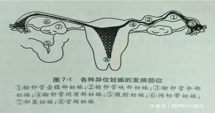 异位妊娠的诊断和治疗，女性朋友都应该知道